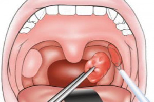 amigdalectomía por radiofrecuencia