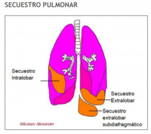 SECUESTRO-PULMONAR