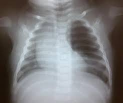 enfisema lobar congenito