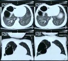 malformaciones broncopulmonares