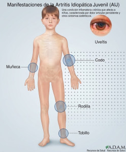 artritis idiopática juvenil