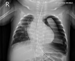 neumotorax en pediatría