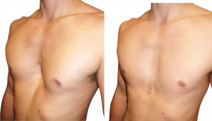 Pectus Excavatum