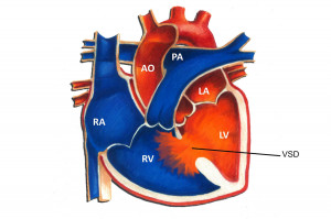 civ comunicacion interventricular