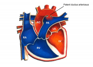 persistencia del ductus arterioso