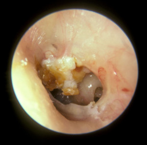 colesteatoma