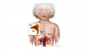 Adrenocortical Carcinoma