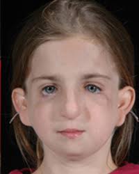 sindrome de treacher collins