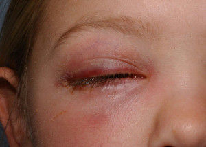 celulitis periorbital