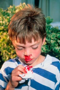 epistaxis