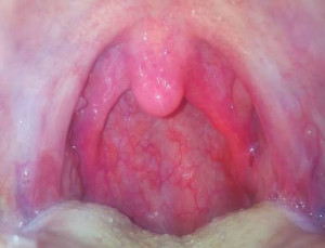 faringitis y amigdalitis