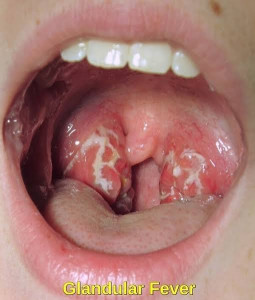 mononucleosis infecciosa